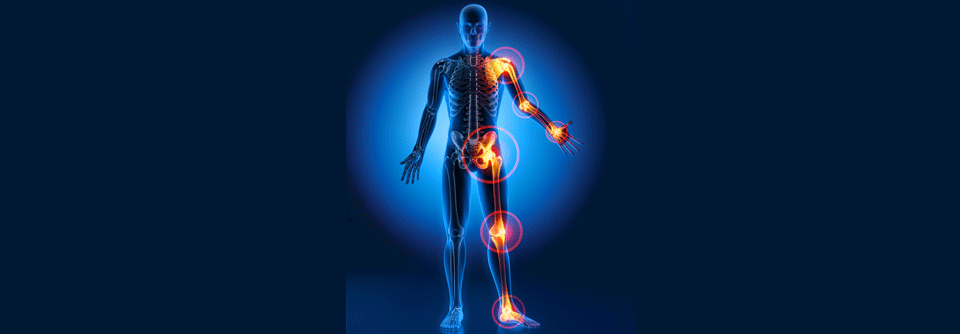 Hämochromatose-Arthropathie: Klassifiaktionskriterien sind da Eine Gelenkbeteiligung bei Hämochromatose bleibt oft unerkannt.
