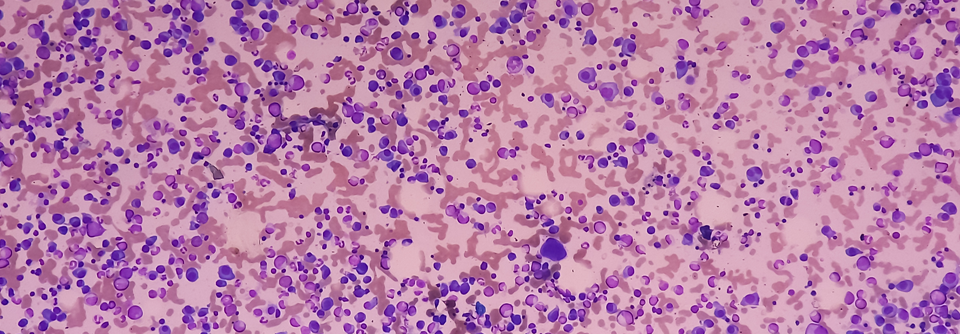 Schon Frühstufe des Myeloms behandeln Ärzt:innen der Phase-3-Studie AQUILA überwachten das Fortschreiten des Smouldering Myelomas unter Einnahme von Daratumumab.