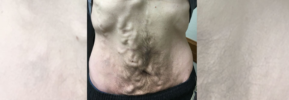 Seinen Namen erhielt das Krankheitsbild aufgrund seiner Ähnlichkeit mit dem gorgonischen Schlangenhaar (Agenturfoto).