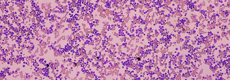 Die AML geht oftmals mit Anämie und Thrombozytopenie einher.