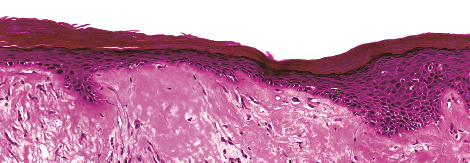 Lichen sclerosus: S3-Leitlinie mit neuen Empfehlungen Es kann bei fortgeschrittenem Lichen sclerosus zu Fissuren, Vernarbungen, strukturellen Fusionen und Atrophie kommen.