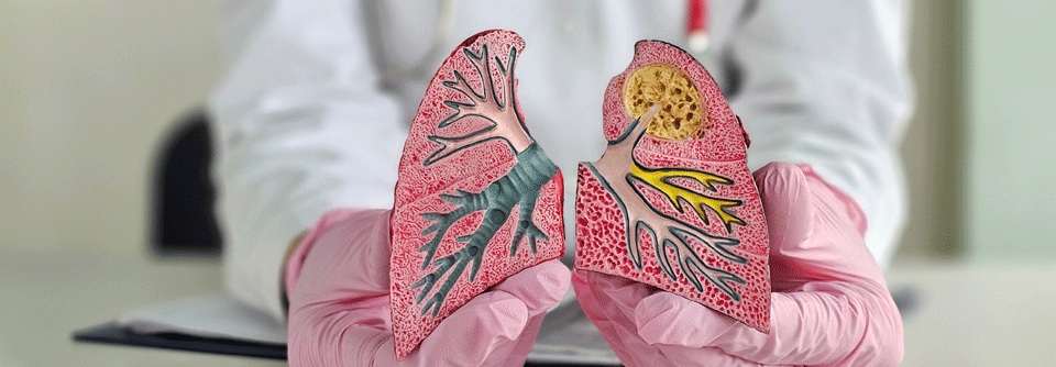 NSCLC-Patient:innen mit RET-Fusionen haben mit Selpercatinib ein um 53 % geringeres Progressionsrisiko als mit Placebo.


