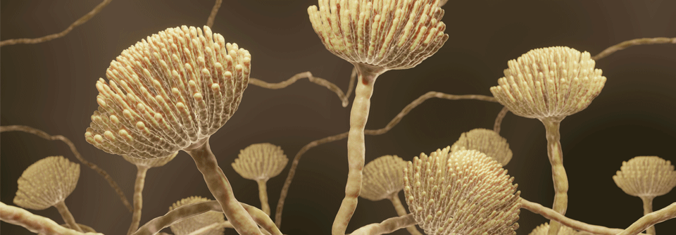 Eine allergische bronchopulmonale Aspergillose (ABPA) ist charakterisiert durch eine unangemessene Immunreaktion auf Aspergillus fumigatus.
