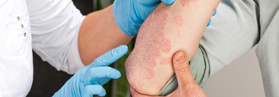Neue Metaanalyse definiert erfolgreichste Switch-Strategien bei Biologika-Therapie.