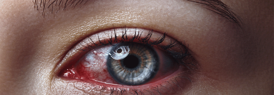 Eine Uveitis kann harmlos beginnen – aber dramatisch enden.