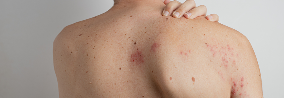 Herpes zoster: Baden-Württemberg und Bayern haben die niedrigsten Impfquoten Organisierte Praxen und Honoraranreize sollen die Herpes-zoster-Impfquote in Zukunft verbessern.
