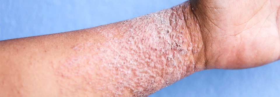 Atopische Dermatitis: Neue Systemtherapien im Fokus Menschen mit schwerer atopischer Dermatitis profitieren von neuen personalisierten Therapieansätzen.
