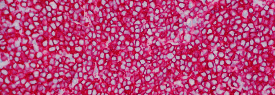 Das B-Zell-Lymphom ist eine gefürchtete Komplikation beim Sjögren-Syndrom