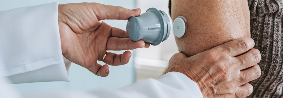 Die kontinuierliche Glukosemessung mit einem Sensor auf dem Arm ist bei Menschen mit Typ-2-Diabetes aufgrund der Vorgaben des G-BA nur eingeschränkt zulasten der gesetzlichen Krankenversicherung möglich.