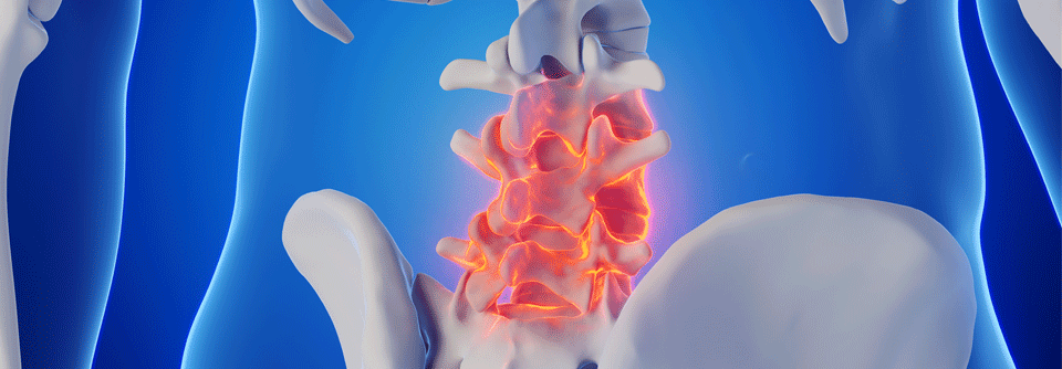 Was tun, wenn bei einer axialen Spondyloarthritis nach dem NSAR auch das Biologikum nicht greift?