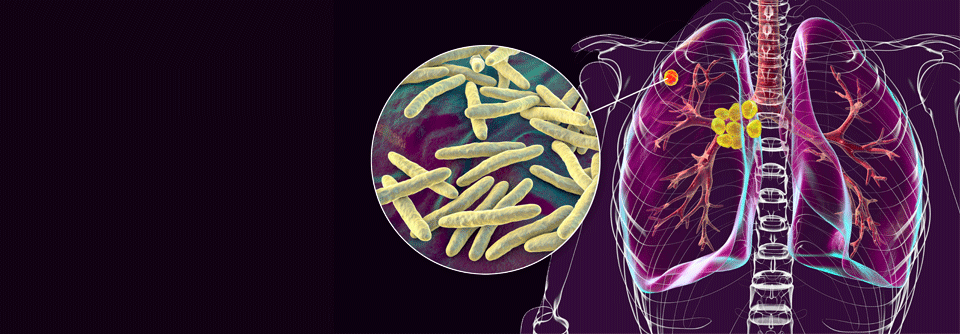 Weniger als die Hälfte der Tuberkulosefälle mit (Multi-)Resistenz wird korrekt diagnostiziert und behandelt.