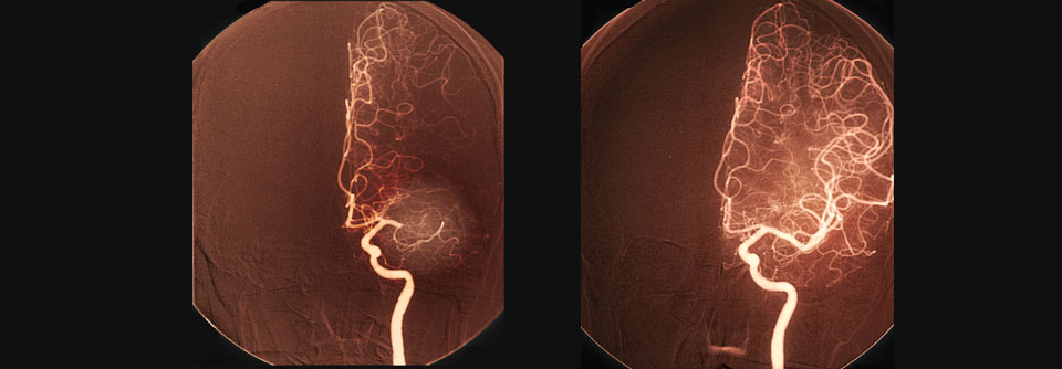 Hirnarterien einer 54-jährigen Patientin mit Mediainfarkt vor und nach der Thrombolyse.