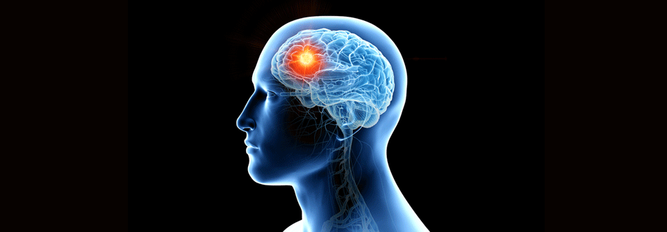 Moderne Systemtherapien wie TKI, ADC und Kombinationstherapien zeigen Erfolge bei Hirnmetastasen.
