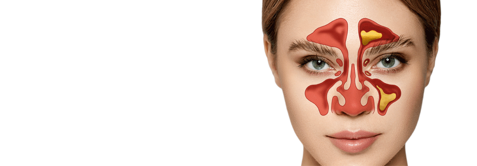 Eine gestörte Darmflora ist mit chronischer Sinusitis assoziiert.