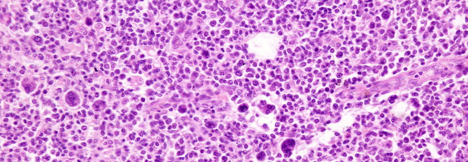 Lymphknoten einer erkrankten Person mit Hodgkin-Lymphom.