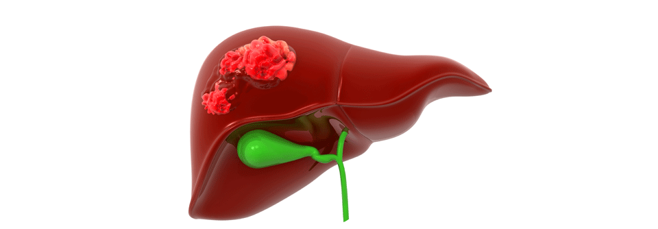 Eine Transplantation bietet bei isolierten Lebermetastasen Heilungschancen - aber eine Resektion sofern möglich, ebenfalls
