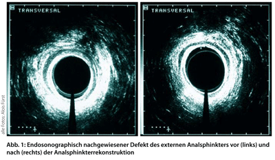 Abb. 1: Edosonographisch nachgewiesener defekt des externen Analsphinkters vor (links) und nach (rechts) der Analsphinkterrekonstruktion.