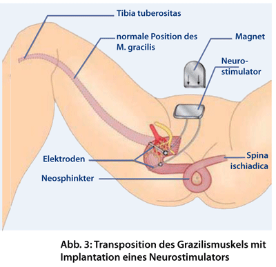 Abb. 3: Transposition des Grazilismuskels mit Implantation eines Neurostimulators.