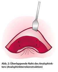Abb. 2: Überlappende Naht des Analsphinkters (Analsphinkterrekonstruktion).