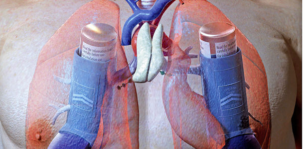Asthma bronchiale: Leicht diagnostizieren und optimal behandeln