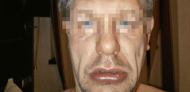 Zwischenfall im Biergarten: Was verursachte das Quincke-Ödem?