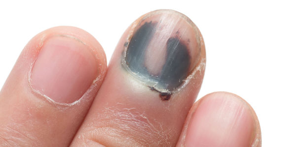 Abrechnungs-Tipp: Nageltrepanation