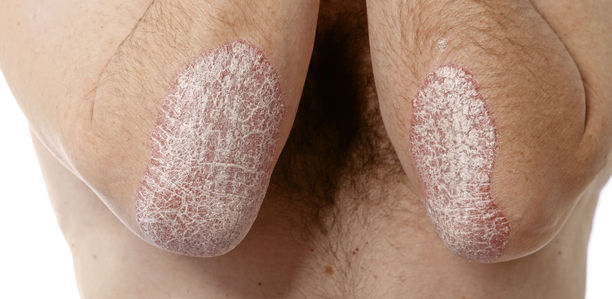 Psoriasis: Mehr als eine Hauterkrankung