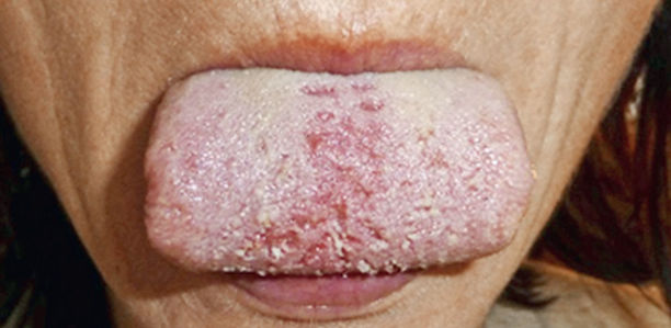 Brennen in Zunge und Mund: Kennen Sie das Burning-Mouth-Syndrom? Studienabhängig wird in der Allgemeinbevölkerung eine BMS-Prävalenz von 1 bis 8 % angenommen.