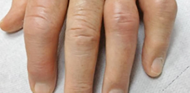 Gicht: Die Tücken der Diagnostik
