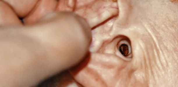 Ohrenschmalz: Cerumen entfernen – wenn, dann mit Gefühl!