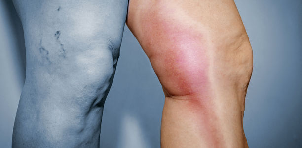 Hormonelle Verhütung : Thromboserisiko beachten!