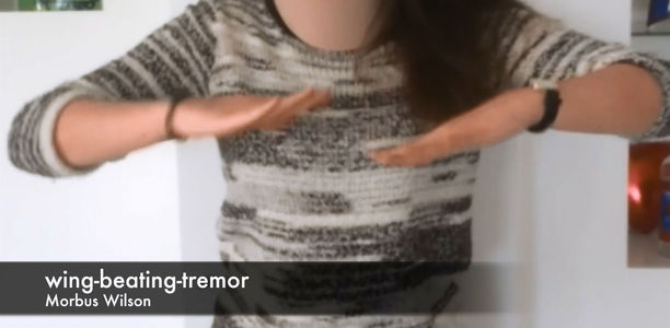 Typisch für Morbus Wilson: Der Wing-beating-Tremor