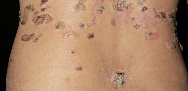 Blasen an Haut und Schleimhaut: Steckt ein Immundefekt dahinter?