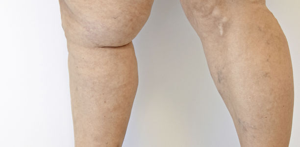 Dicke Beine: Woher kommen die Ödeme?