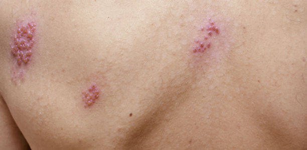 Herpes zoster: Was ist Mittel der Wahl?