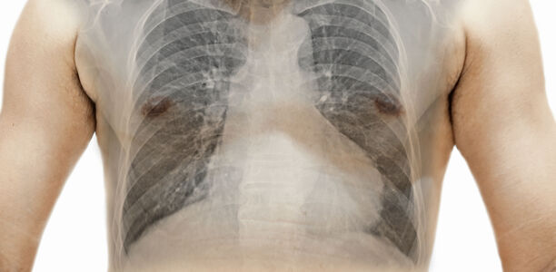 Asthma und COPD: Wann kommen ICS zum Zug?