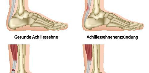 Achillessehnenriss ...: ... muss nicht operiert werden