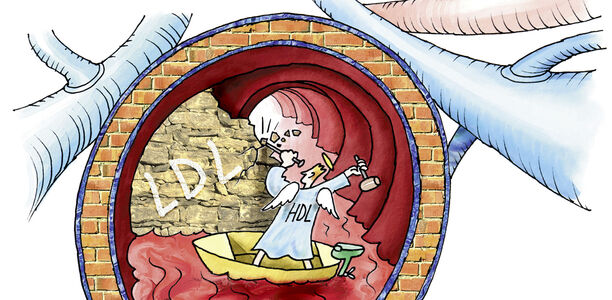 Dyslipidämie: Cholesterin senken – wann und womit?