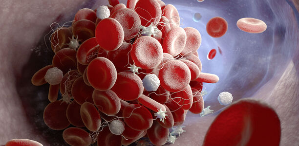 Patientin mit Tetraparese: Wie lange Thromboseprophylaxe und PPI?
