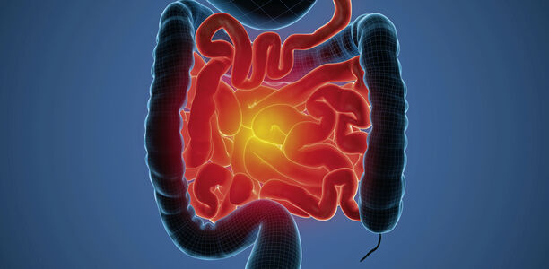 M. Crohn und C. ulcerosa: Frühzeitige Therapie kann Komplikationen vermeiden