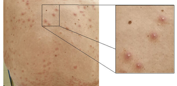 Pseudomonas-Follikulitis: Kennen Sie die Whirlpool-Dermatitis? Verursacht wird die Pseudomonas-Follikulitis durch eine bakterielle Infektion der Haarfollikel