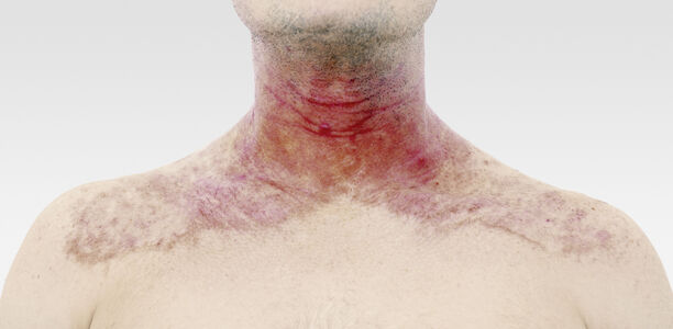 Atopisches Ekzem: Neurodermitis-Symptome lindern
