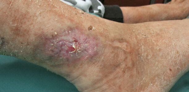 Chronisches Ulcus cruris: Ursachen und Therapieoptionen beim „offenen Bein“