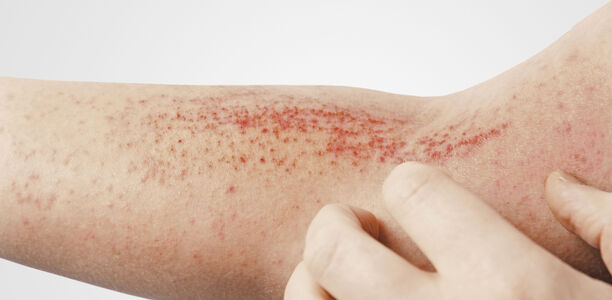 Positionspapier: Biologika bei atopischer Dermatitis