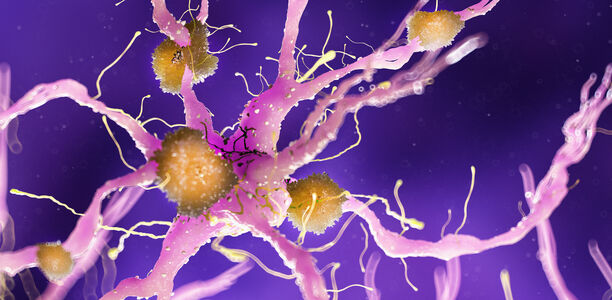 Demenz: Alzheimer ist nicht übertragbar Beispiele für Prionen-Erkrankungen sind BSE (bovine spongiforme Enzephalopathie) bei Kühen oder CJD (Creutzfeldt-Jacob Erkrankung) beim Menschen.