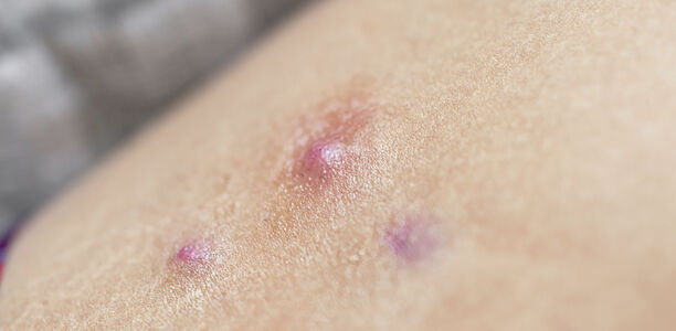 Acne inversa: Neuer Wirkstoff bei Acne inversa?
