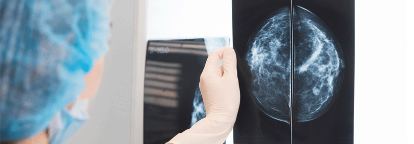 Verlängerung der adjuvanten endokrinen Therapie beim frühen Brustkrebs?
