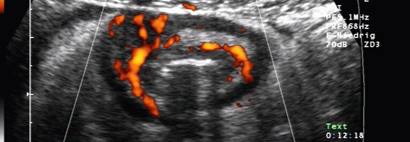 Wandverdicktes Ileum bei akutem Schub eines M. Crohn mit verstärkter Durchblutung der Darmwand.