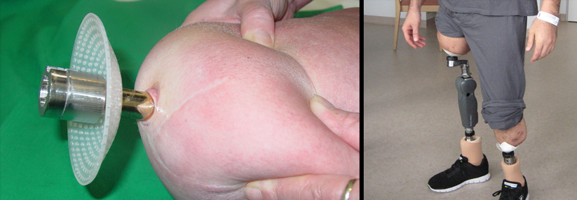 links: Um die Endo-Exo-Prothese anzuschließen, leitet man das Implantat durch ein Stoma nach draußen. rechts: Klinischer Befund zwei Tage nach der Implantation.