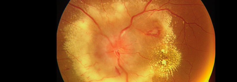 Damit der Hochdruck nicht ins Auge geht Ein Patient Ende zwanzig wird wegen einer akuten Blutdruckentgleisung (275/195 mmHg) notfallmäßig stationär eingewiesen. Seit einem Monat leidet er unter einer Sehverschlechterung und Kopfschmerzen. Die Augenspiegelung ergibt einen Fundus hypertonicus Stadium IV mit Papillenödem und ausgedehnten Lipidablagerungen.